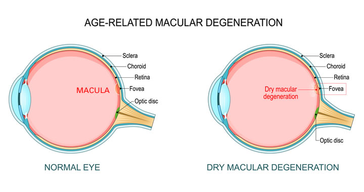 Age Related Macular Degeneration