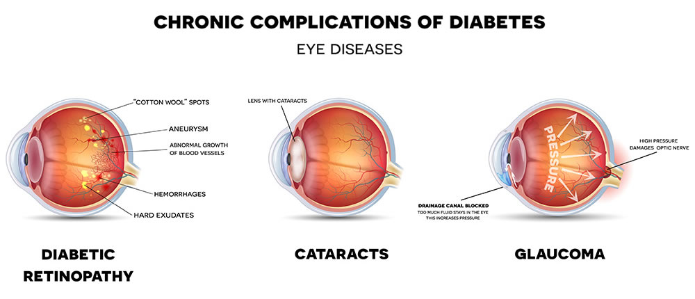 Complications of Diabetic Eye Diseases