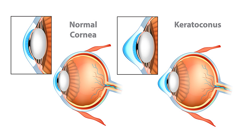 Keratoconus Corneal Cross-Linking